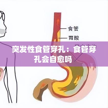 突發(fā)性食管穿孔：食管穿孔會(huì)自愈嗎 